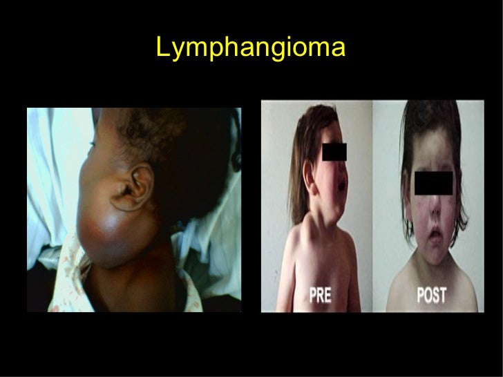 headache paracetamol Head and neck pathology headache paracetamol Head and neck pathology