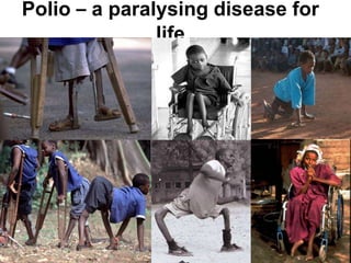 Polio – a paralysing disease for
life
 