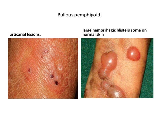 impetigo scarring #11