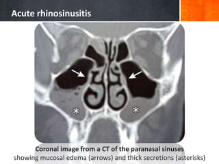 Acute rhinosinusitis
Coronal image from a CT of the paranasal sinuses
showing mucosal edema (arrows) and thick secretions (asterisks)
 