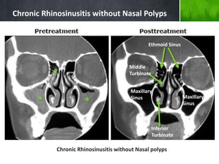 Chronic Rhinosinusitis without Nasal Polyps
Chronic Rhinosinusitis without Nasal polyps
Ethmoid Sinus
Maxillary
Sinus Maxillary
Sinus
Middle
Turbinate
Inferior
Turbinate
* *
*
 