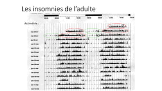 Les insomnies de l’adulte 
Actimétrie : 
J1 
J1 N1 
N1 
J2 
J2 N2 
 