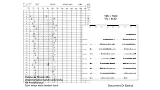 Femme de 58 ans (JB) 
Insomnie après rupture anévrysme 
Ne travaille plus 
Dort mieux mais s’endort tard 
TRN = 7h00 
TPL = 8h30 
Document Dr Bastuji 
 
