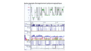 Autre exemple d’enregistrement polysomnographique. 
 