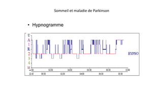 Sommeil et maladie de Parkinson 
• Hypnogramme 
 