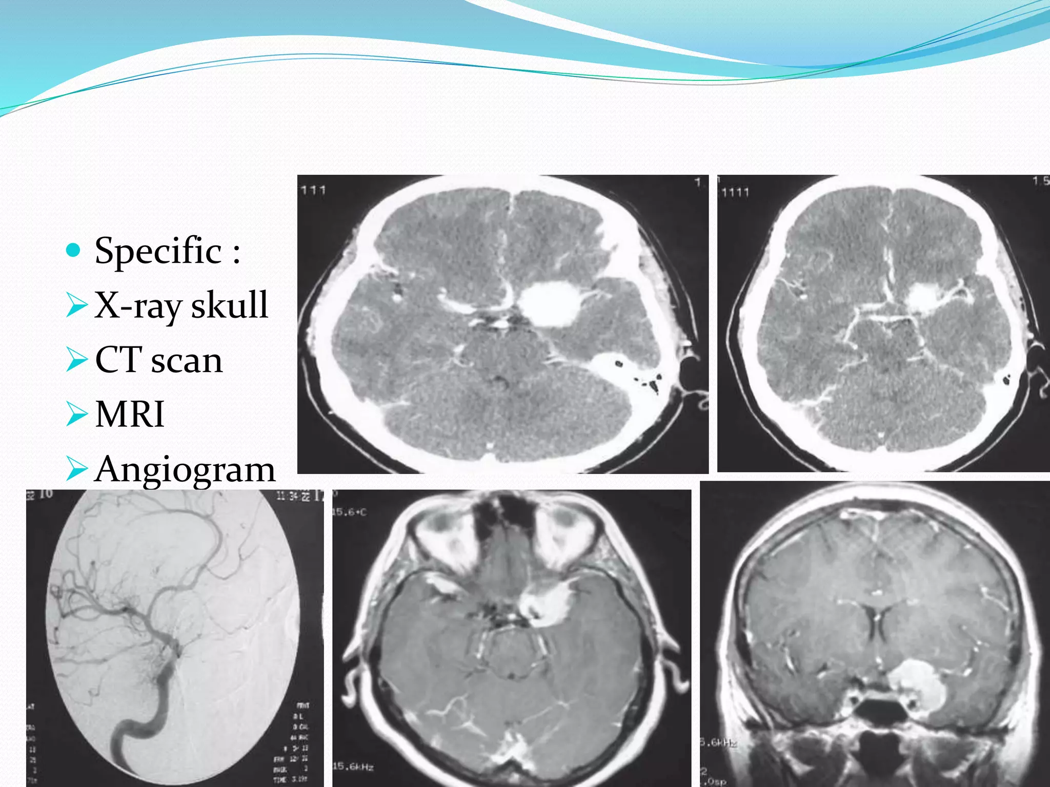 Clinoidal meningioma | PPTX