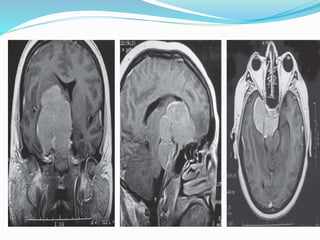 Clinoidal meningioma | PPTX