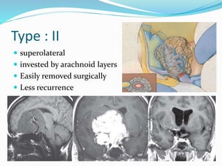 Clinoidal meningioma | PPTX