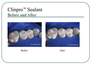 Clinpro Sealant.ppt