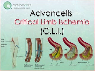 Critical Limb Ischemia (CLI)