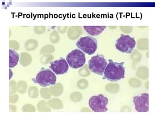 T-Prolymphocytic Leukemia (T-PLL) 