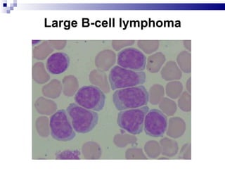 Large B-cell lymphoma 