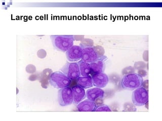 Large cell immunoblastic lymphoma 