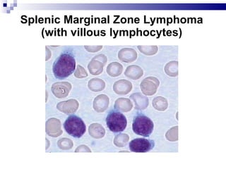 Splenic Marginal Zone Lymphoma (with villous lymphocytes) 