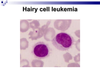 Hairy cell leukemia 