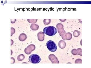 Lymphoplasmacytic lymphoma 