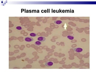 Plasma cell leukemia 