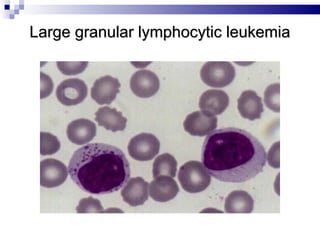 Large granular lymphocytic leukemia 