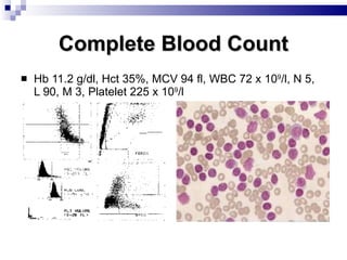 Complete Blood Count Hb 11.2 g/dl, Hct 35%, MCV 94 fl, WBC 72 x 10 9 /l, N 5, L 90, M 3, Platelet 225 x 10 9 /l 