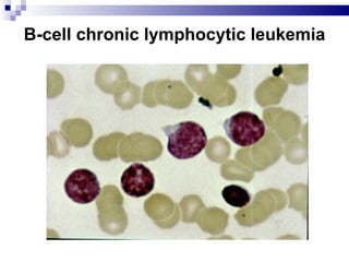 B-cell chronic lymphocytic leukemia 