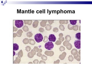 Mantle cell lymphoma 