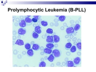Prolymphocytic Leukemia (B-PLL) 