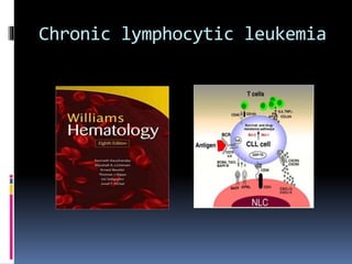 Chronic lymphocytic leukemia
 