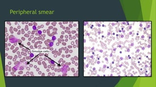 Peripheral smear
 