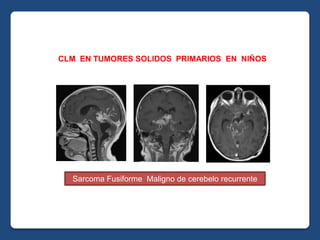 CLM EN TUMORES SOLIDOS PRIMARIOS EN NIÑOS
Sarcoma Fusiforme Maligno de cerebelo recurrente
 