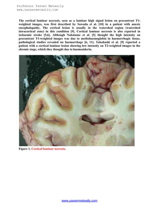 Professor Yasser Metwally
www.yassermetwally.com

The cortical laminar necrosis, seen as a laminar high signal lesion on precontrast T1weighted images, was first described by Sawada et al. [10] in a patient with anoxic
encephalopathy. The cortical lesion is usually in the watershed region (watershed
intracortical zone) in this condition [9]. Cortical laminar necrosis is also reported in
ischaemic stroke [5,6]. Although Nabatame et al. [5] thought the high intensity on
precontrast T1-weighted images was due to methohaemoglobin in haemorrhagic tissue,
pathological studies revealed no haemorrhage [6, 11]. Takahashi et al. [9] reported a
patient with a cortical laminar lesion showing low intensity on T2-weighted images in the
chronic stage, which they thought due to haemosiderin.

Figure 1. Cortical laminar necrosis.

www.yassermetwally.com

 