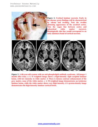 Professor Yasser Metwally
www.yassermetwally.com

Figure 2. Cortical laminar necrosis. Early in
the disease, gross findings will be characterized
by edema and swelling. Note the swollen
glistening appearance of the cerebral cortex.
Note the vague line between cortex and
subcortical
white
matter
(arrows).
Histologically this line would correspond to an
early (laminar) band of cortical necrosis.

Figure 3. A 60-year-old woman with an anti phospholipid antibody syndrome. All images 1
month after ictus. a A Tl weighted image shows a high-intensity right occipital laminar
lesion, with low intensity in white matter. b There is intense contrast enhancement of the
grey matter, none of the white matter. c A T2-weighted image demonstrates an isointense
laminar lesion, while the white matter shows very high intensity. d A proton-density image
demonstrates the high-intensity laminar cortical lesion.

www.yassermetwally.com

 