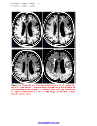 Professor Yasser Metwally
www.yassermetwally.com

Figure 4. A 73-year-old man with speech disturbance. a At 1.5 months after
the ictus, a precontrast T1-weighted image demonstrates a high-intensity left
parietal laminar lesion (arrow). B, At 6 months, there is no high intensity and
no contrast enhancement (C), but a FLAIR image (D) still shows a highintensity laminar lesion.

www.yassermetwally.com

 