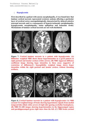 Professor Yasser Metwally
www.yassermetwally.com



Hypoglycemia

First described in a patient with anoxic encephalopathy, it was found later that
laminar cortical necrosis represented cytotoxic oedema affecting a particular
layer of cerebral cortex neuropathologically characterised by delayed selective
neuronal necrosis and is a consequence of hypoxic-ischaemic encephalopathy,
hypoglycaemic encephalopathy, status epilepticus and ischaemic stroke.
Mechanisms of laminar cortical necrosis are not well elucidated.

Figure 7. Cortical laminar necrosis in a patient with hypoglycemia. (A)
Diffusion- weighted MRI shows linear hyperintensities in a gyral pattern in
right parietal and insular cortices (white arrow). (B) MRI Apparent diffusion
coefficient image showing hypo intensities in these areas suggestive of
restriction of diffusion.(C) Susceptibility weighted image shows hyper
intensities within the right parietal and insular cortices without blooming
artifacts.

Figure 8. Cortical laminar necrosis in a patient with hypoglycemia (A) MRI
coronal T2-weighted image of brain showing hyperintense signals from medial
temporal lobe (thick white arrow) of right side sparing cerebellar hemispheres.
(B) MRI FLAIR images showing hyperintensities in the hippocampal region
and parahippocampal gyrus right more than the left. (C) MRI brain coronal

www.yassermetwally.com

 