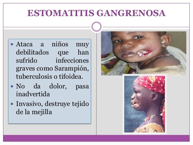 ESTOMATITIS GANGRENOSA PDF ESTOMATITIS GANGRENOSA PDF