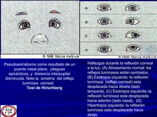 Pseudoestrabismo como resultado de un
puente nasal plano, pliegues
epicánticos, y distancia interpupilar
disminuida. Note la simetría del reflejo
luminoso corneal.
Test de Hirschberg
Hallazgos durante la reflexión corneal
a la luz. (A) Alineamiento normal: los
reflejos luminosos están centrados.
(B) Esotropia izquierda: la reflexión
luminosa (reflejo corneal) esta
desplazada hacia afuera (lado
temporal). (C) Exotropia izquierda: la
reflexión luminosa esta desplazada
hacia adentro (lado nasal). (D)
Hipertropia izquierda: la reflexión
luminosa esta desplazada hacia
abajo.
 