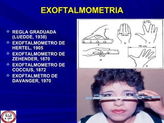 EXOFTALMOMETRIAEXOFTALMOMETRIA
 REGLA GRADUADAREGLA GRADUADA
(LUEDDE, 1938)(LUEDDE, 1938)
 EXOFTALMOMETRO DEEXOFTALMOMETRO DE
HERTEL, 1905HERTEL, 1905
 EXOFTALMOMETRO DEEXOFTALMOMETRO DE
ZEHENDER, 1870ZEHENDER, 1870
 EXOFTALMOMETRO DEEXOFTALMOMETRO DE
COCCIUS, 1872COCCIUS, 1872
 EXOFTALMETRO DEEXOFTALMETRO DE
DAVANGER, 1970DAVANGER, 1970
 