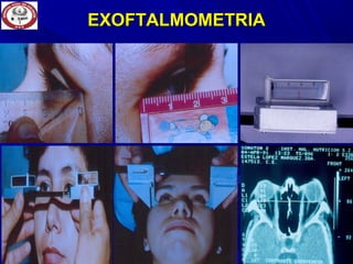 EXOFTALMOMETRIAEXOFTALMOMETRIA
 