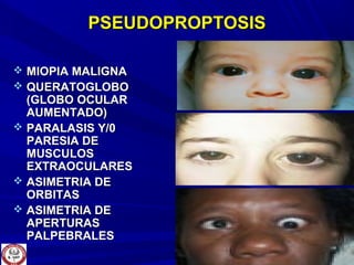 PSEUDOPROPTOSISPSEUDOPROPTOSIS
 MIOPIA MALIGNAMIOPIA MALIGNA
 QUERATOGLOBOQUERATOGLOBO
(GLOBO OCULAR(GLOBO OCULAR
AUMENTADO)AUMENTADO)
 PARALASIS Y/0PARALASIS Y/0
PARESIA DEPARESIA DE
MUSCULOSMUSCULOS
EXTRAOCULARESEXTRAOCULARES
 ASIMETRIA DEASIMETRIA DE
ORBITASORBITAS
 ASIMETRIA DEASIMETRIA DE
APERTURASAPERTURAS
PALPEBRALESPALPEBRALES
 