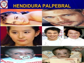 HENDIDURA PALPEBRALHENDIDURA PALPEBRAL
 
