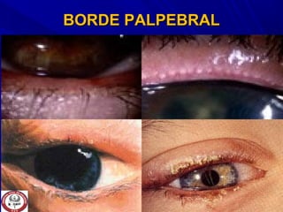 BORDE PALPEBRALBORDE PALPEBRAL
 