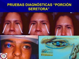 PRUEBAS DIAGNÓSTICAS “PORCIÓNPRUEBAS DIAGNÓSTICAS “PORCIÓN
SERETORA”SERETORA”
 