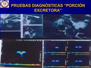 PRUEBAS DIAGNÓSTICAS “PORCIÓNPRUEBAS DIAGNÓSTICAS “PORCIÓN
EXCRETORA”EXCRETORA”
 