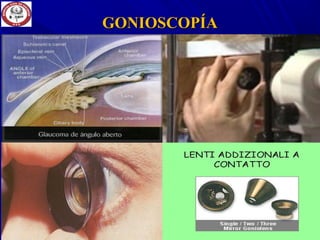 GONIOSCOPÍAGONIOSCOPÍA
 