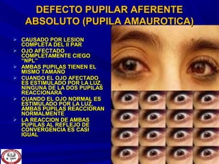  CAUSADO POR LESIONCAUSADO POR LESION
COMPLETA DEL II PARCOMPLETA DEL II PAR
 OJO AFECTADOOJO AFECTADO
COMPLETAMENTE CIEGOCOMPLETAMENTE CIEGO
“NPL”“NPL”
 AMBAS PUPILAS TIENEN ELAMBAS PUPILAS TIENEN EL
MISMO TAMAÑOMISMO TAMAÑO
 CUANDO EL OJO AFECTADOCUANDO EL OJO AFECTADO
ES ESTIMULADO POR LA LUZ,ES ESTIMULADO POR LA LUZ,
NINGUNA DE LA DOS PUPILASNINGUNA DE LA DOS PUPILAS
REACCIONARAREACCIONARA
 CUANDO EL OJO NORMAL ESCUANDO EL OJO NORMAL ES
ESTIMULADO POR LA LUZ,ESTIMULADO POR LA LUZ,
AMBAS PUPILAS REACCIORANAMBAS PUPILAS REACCIORAN
NORMALMENTENORMALMENTE
 LA REACCION DE AMBASLA REACCION DE AMBAS
PUPILAS AL REFLEJO DEPUPILAS AL REFLEJO DE
CONVERGENCIA ES CASICONVERGENCIA ES CASI
IGUALIGUAL
DEFECTO PUPILAR AFERENTEDEFECTO PUPILAR AFERENTE
ABSOLUTO (PUPILA AMAUROTICA)ABSOLUTO (PUPILA AMAUROTICA)
 