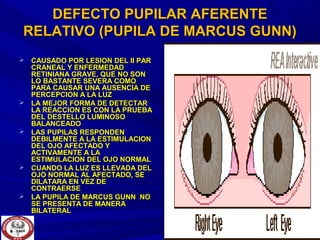  CAUSADO POR LESION DEL II PARCAUSADO POR LESION DEL II PAR
CRANEAL Y ENFERMEDADCRANEAL Y ENFERMEDAD
RETINIANA GRAVE, QUE NO SONRETINIANA GRAVE, QUE NO SON
LO BASTANTE SEVERA COMOLO BASTANTE SEVERA COMO
PARA CAUSAR UNA AUSENCIA DEPARA CAUSAR UNA AUSENCIA DE
PERCEPCION A LA LUZPERCEPCION A LA LUZ
 LA MEJOR FORMA DE DETECTARLA MEJOR FORMA DE DETECTAR
LA REACCION ES CON LA PRUEBALA REACCION ES CON LA PRUEBA
DEL DESTELLO LUMINOSODEL DESTELLO LUMINOSO
BALANCEADOBALANCEADO
 LAS PUPILAS RESPONDENLAS PUPILAS RESPONDEN
DEBILMENTE A LA ESTIMULACIONDEBILMENTE A LA ESTIMULACION
DEL OJO AFECTADO YDEL OJO AFECTADO Y
ACTIVAMENTE A LAACTIVAMENTE A LA
ESTIMULACION DEL OJO NORMALESTIMULACION DEL OJO NORMAL
 CUANDO LA LUZ ES LLEVADA DELCUANDO LA LUZ ES LLEVADA DEL
OJO NORMAL AL AFECTADO, SEOJO NORMAL AL AFECTADO, SE
DILATARA EN VEZ DEDILATARA EN VEZ DE
CONTRAERSECONTRAERSE
 LA PUPILA DE MARCUS GUNN NOLA PUPILA DE MARCUS GUNN NO
SE PRESENTA DE MANERASE PRESENTA DE MANERA
BILATERALBILATERAL
DEFECTO PUPILAR AFERENTEDEFECTO PUPILAR AFERENTE
RELATIVO (PUPILA DE MARCUS GUNN)RELATIVO (PUPILA DE MARCUS GUNN)
 