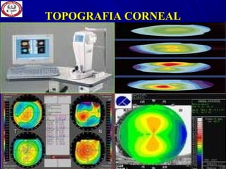 TOPOGRAFIA CORNEALTOPOGRAFIA CORNEAL
 