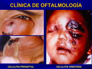 CLÍNICA DE OFTALMOLOGÍACLÍNICA DE OFTALMOLOGÍA
CELULITIS PRESEPTAL CELULITIS ORBITARIA
 