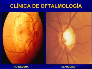 CLÍNICA DE OFTALMOLOGÍACLÍNICA DE OFTALMOLOGÍA
PAPILEDEMA GLAUCOMA
 