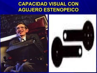 CAPACIDAD VISUAL CONCAPACIDAD VISUAL CON
AGUJERO ESTENOPEICOAGUJERO ESTENOPEICO
 