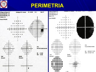 PERIMETRIAPERIMETRIA
 